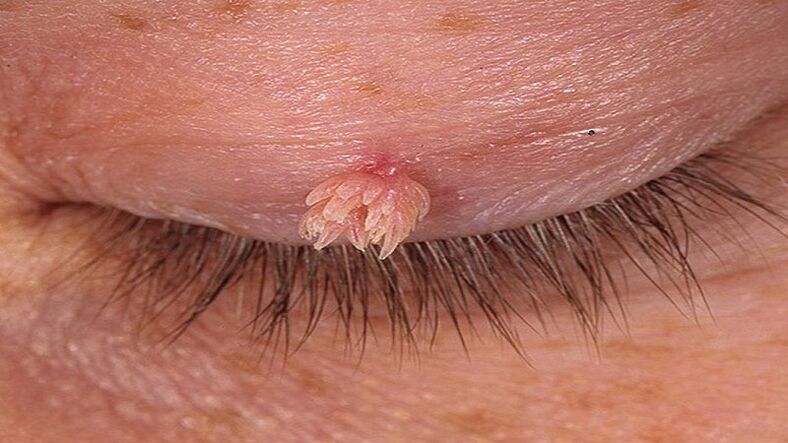 papilloma on the eyelid