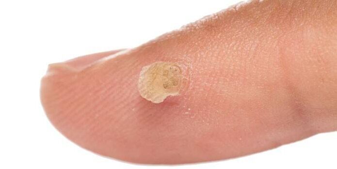 How to treat warts on the finger
