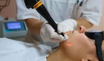 An effective procedure for laser removal of facial papillomas