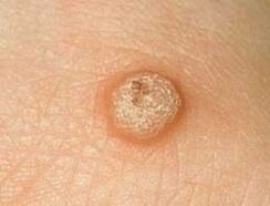 wart vulgaris on the skin