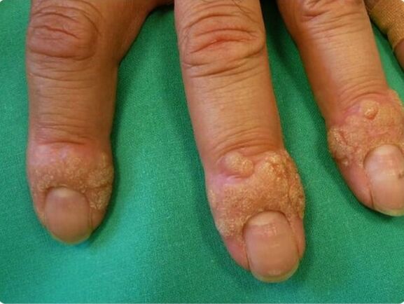 how to remove warts on the fingers