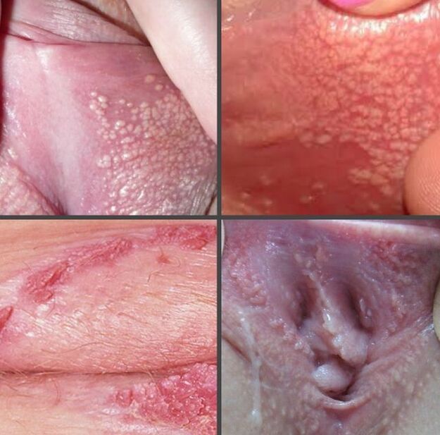 What do lip papillomas look like 