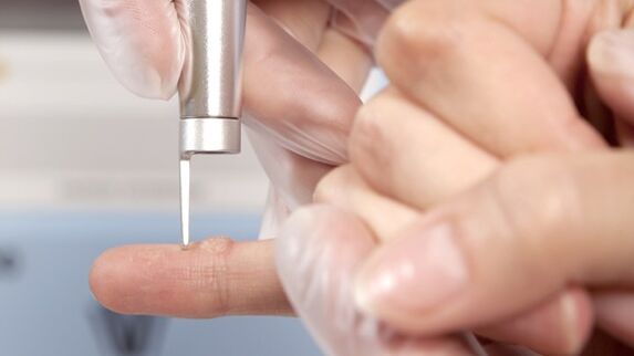 One of the methods of removing warts is the use of a laser