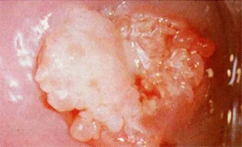 Conside of cervix