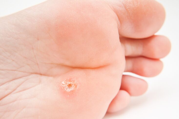 The only warts