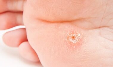 Why does plantar warts appear
