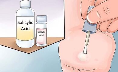 How to get rid of papillomas folk ways