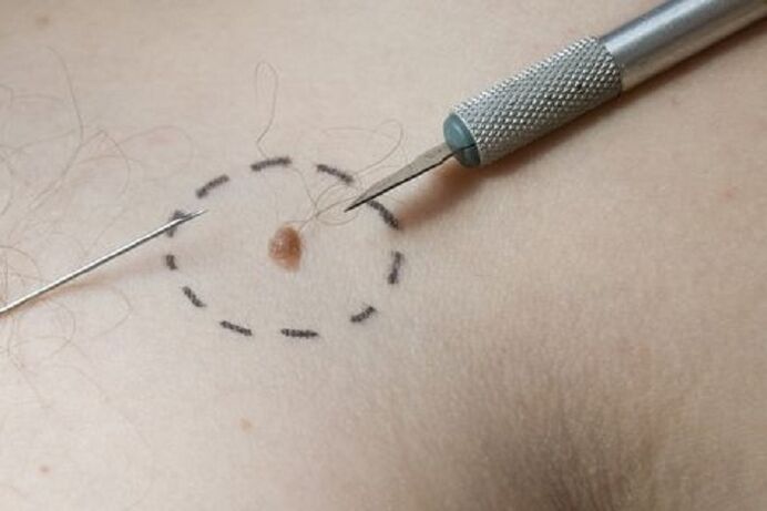 methods of removing warts