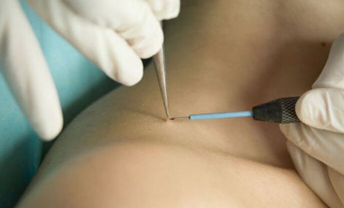 the use of radio wave therapy