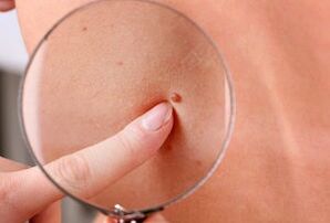 causes of the appearance of papillomas in the human body