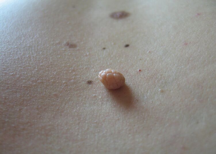 papillomas in the human body