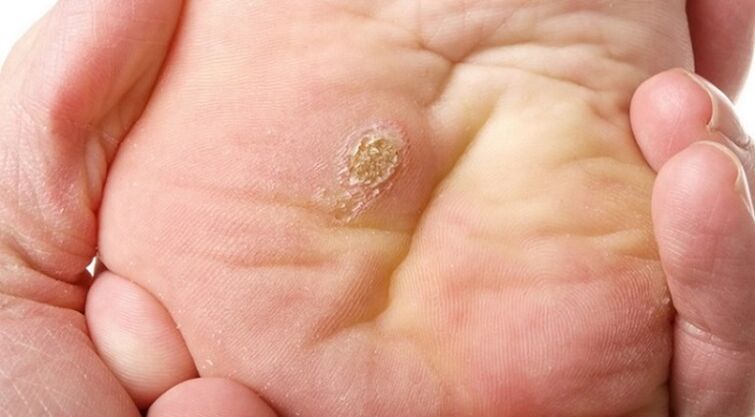 plantar and flat papillomas
