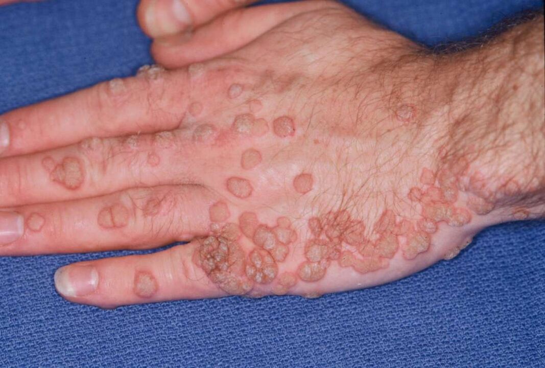 multiple papillomas on the hands