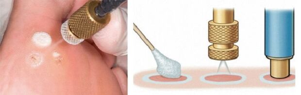 cryodestruction as a method of removal of papillomas