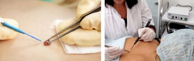 electrocoagulation as a way to eliminate papillomas