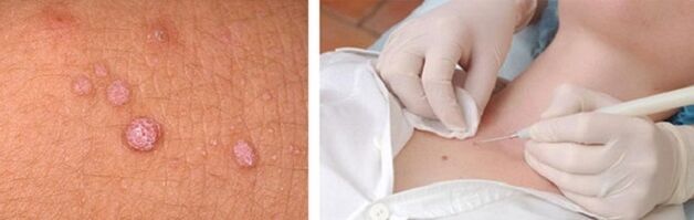 professional removal of papillomas on the body