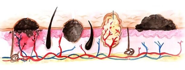 types of papilloma in the human body