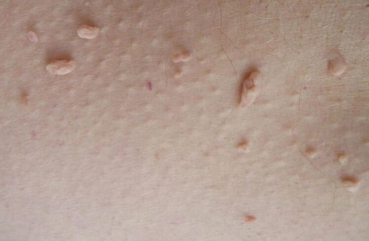 filamentous papillomas on the skin