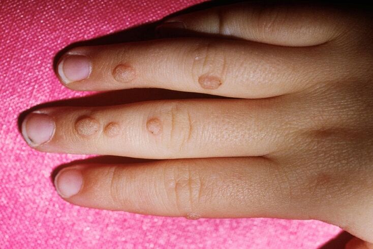 vulgar warts on the fingers