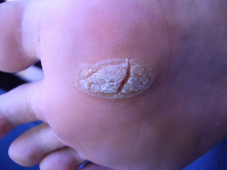 wart on the skin of the leg
