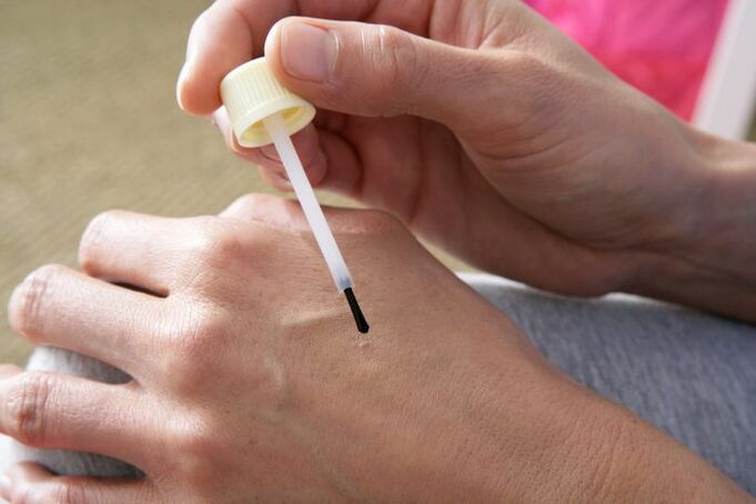 burning warts with celandine juice