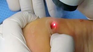 Laser removal of plant warts