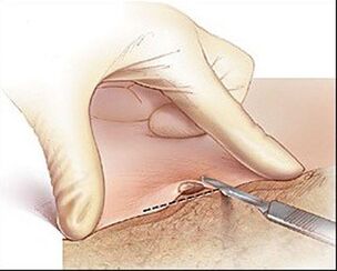 Surgical removal of the wart