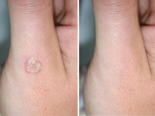 Warts before and after dismantling